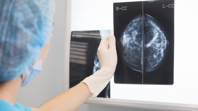 AI 'outperforms' doctors diagnosing breast cancer